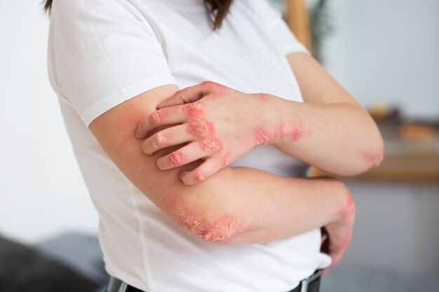 Duloxetine bruising